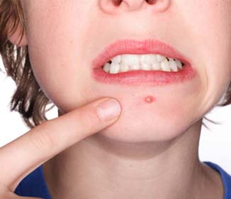 Acne Scar Treatments - Top Acne Products Review